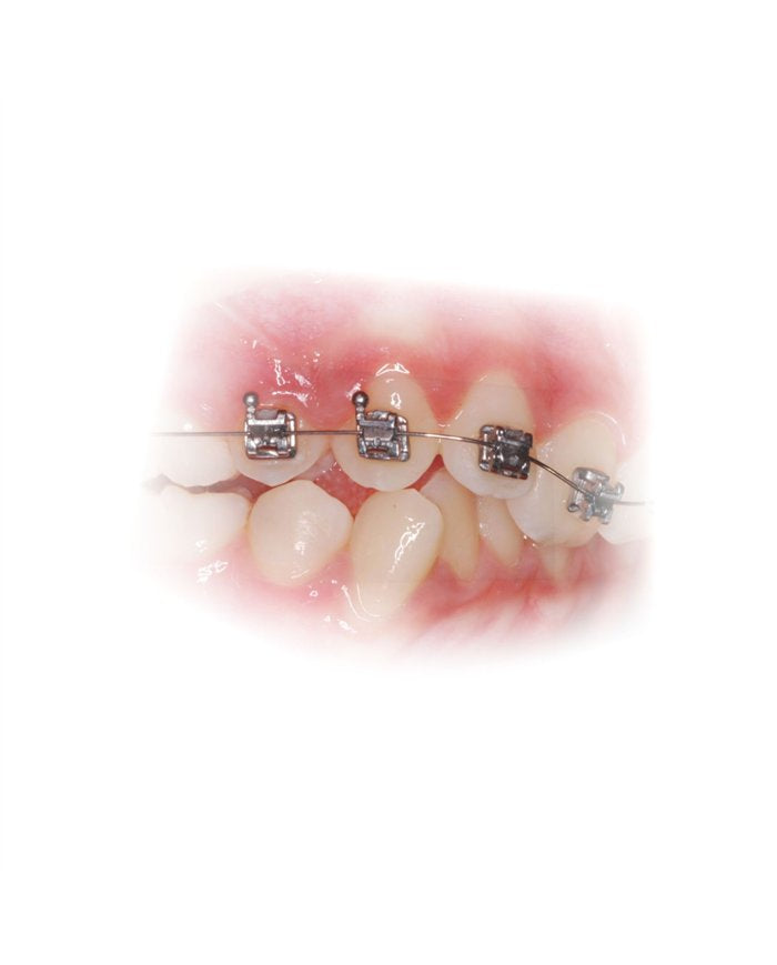 Arcos UltraLeve NiTi Superel -Inf .010"